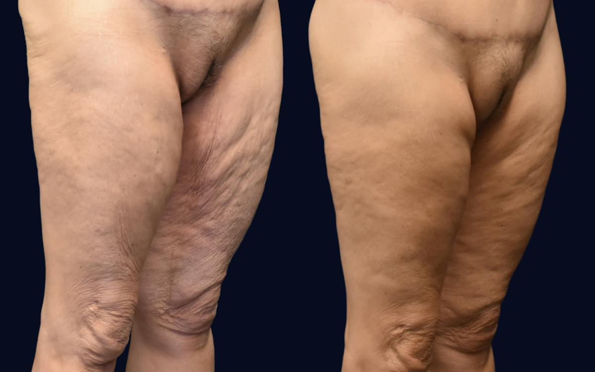 Thigh Lift Before & After Gallery - Patient 390219 - Image 3