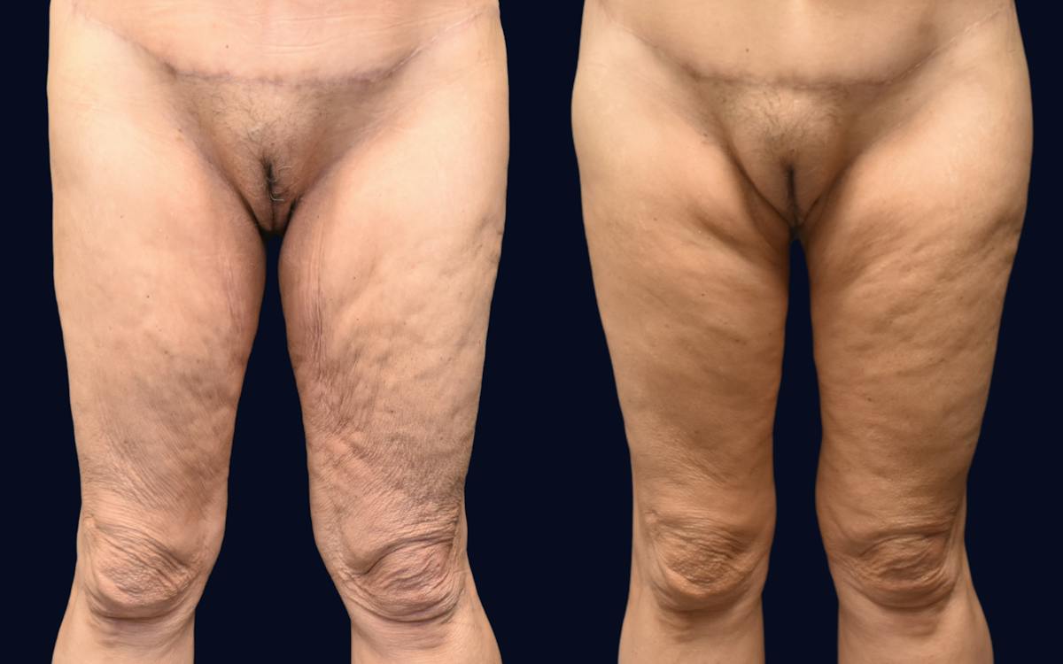 Thigh Lift Before & After Gallery - Patient 390219 - Image 2
