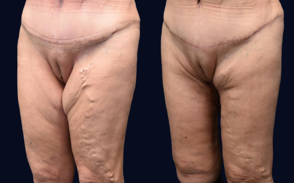 Thigh Lift Before & After Gallery - Patient 148535 - Image 3
