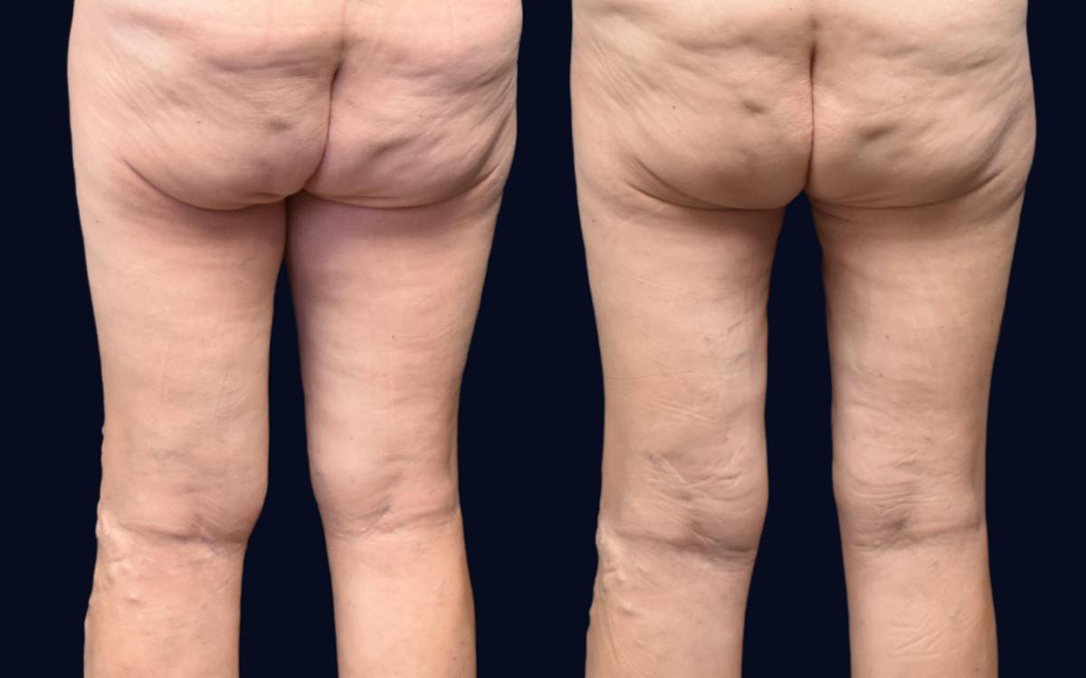Thigh Lift Before & After Gallery - Patient 148535 - Image 1