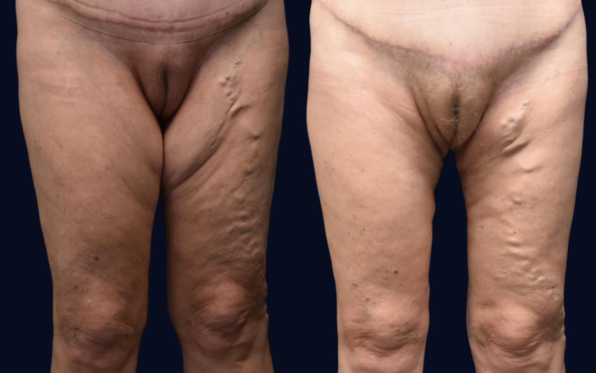 Thigh Lift Before & After Gallery - Patient 148535 - Image 2