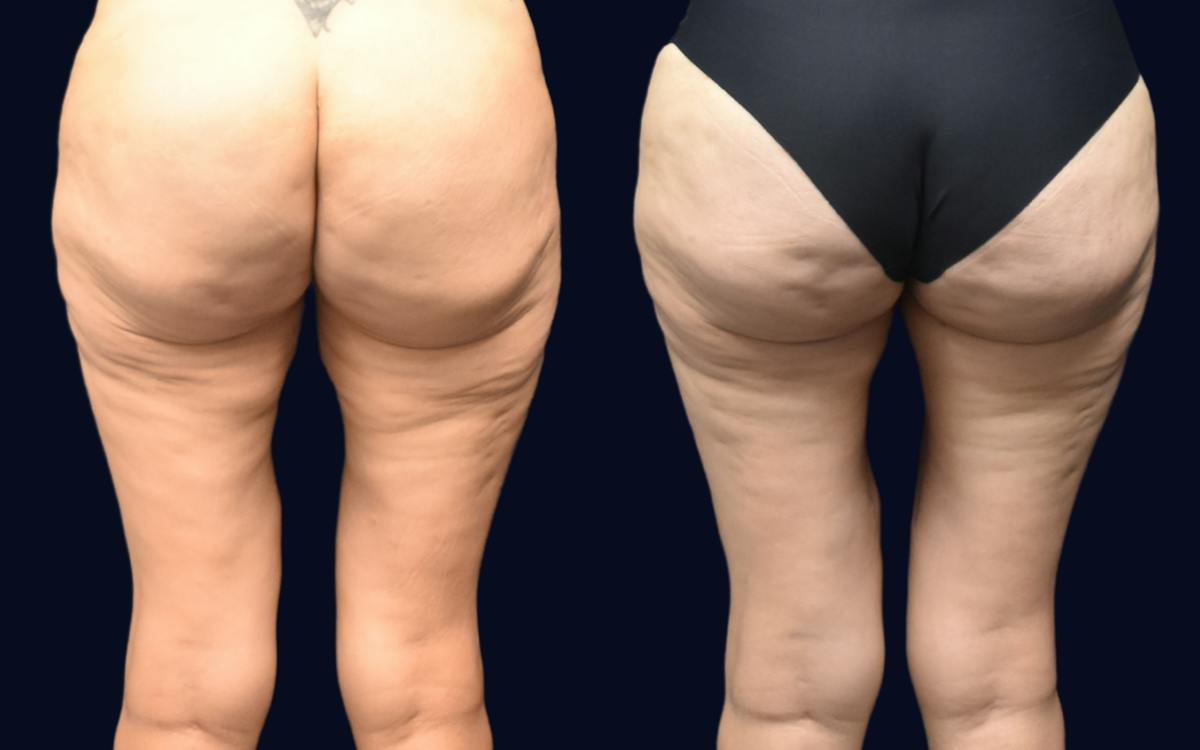 Thigh Lift Before & After Gallery - Patient 240448 - Image 1