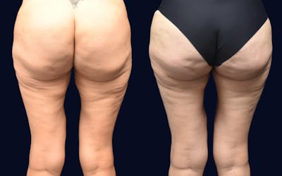 Thigh Lift Before & After Gallery - Patient 240448 - Image 1