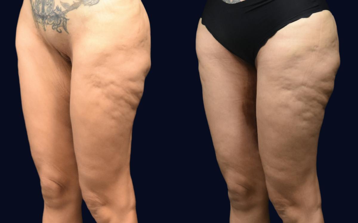 Thigh Lift Before & After Gallery - Patient 240448 - Image 3