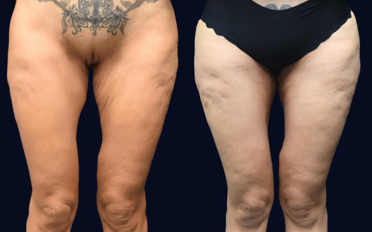 Thigh Lift Before & After Gallery - Patient 240448 - Image 2