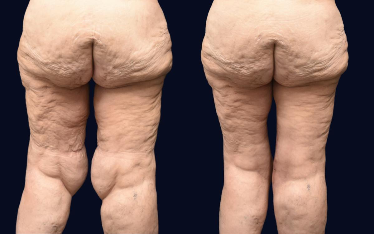 Thigh Lift Before & After Gallery - Patient 295735 - Image 1