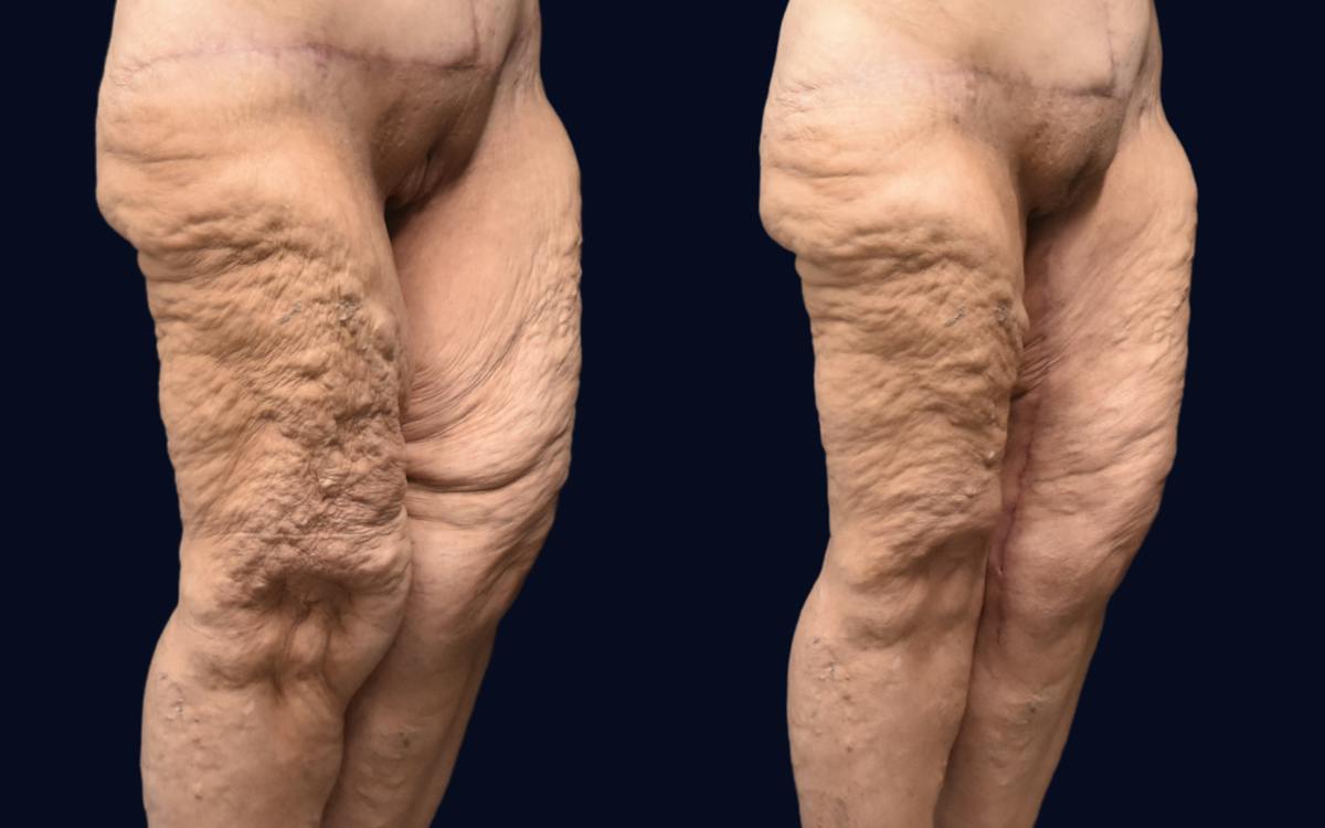 Thigh Lift Before & After Gallery - Patient 295735 - Image 3