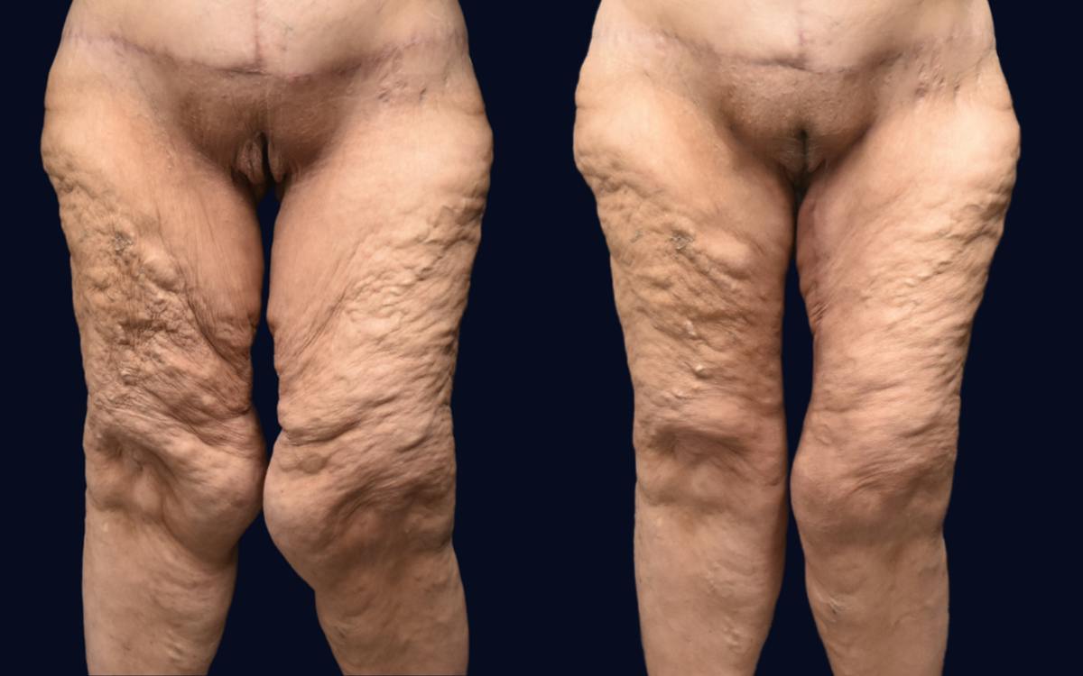 Thigh Lift Before & After Gallery - Patient 295735 - Image 2