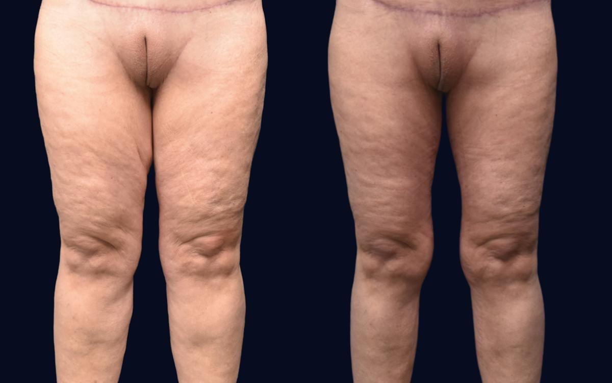 Thigh Lift Before & After Gallery - Patient 163577 - Image 2