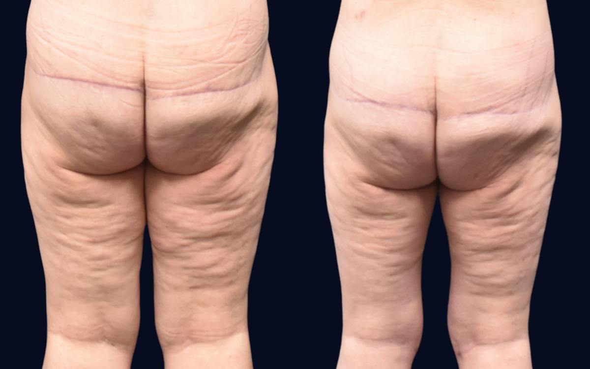 Thigh Lift Before & After Gallery - Patient 163577 - Image 1
