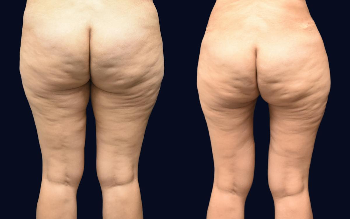 Thigh Lift Before & After Gallery - Patient 837698 - Image 1