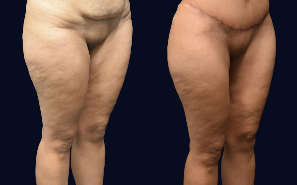 Thigh Lift Before & After Gallery - Patient 837698 - Image 3