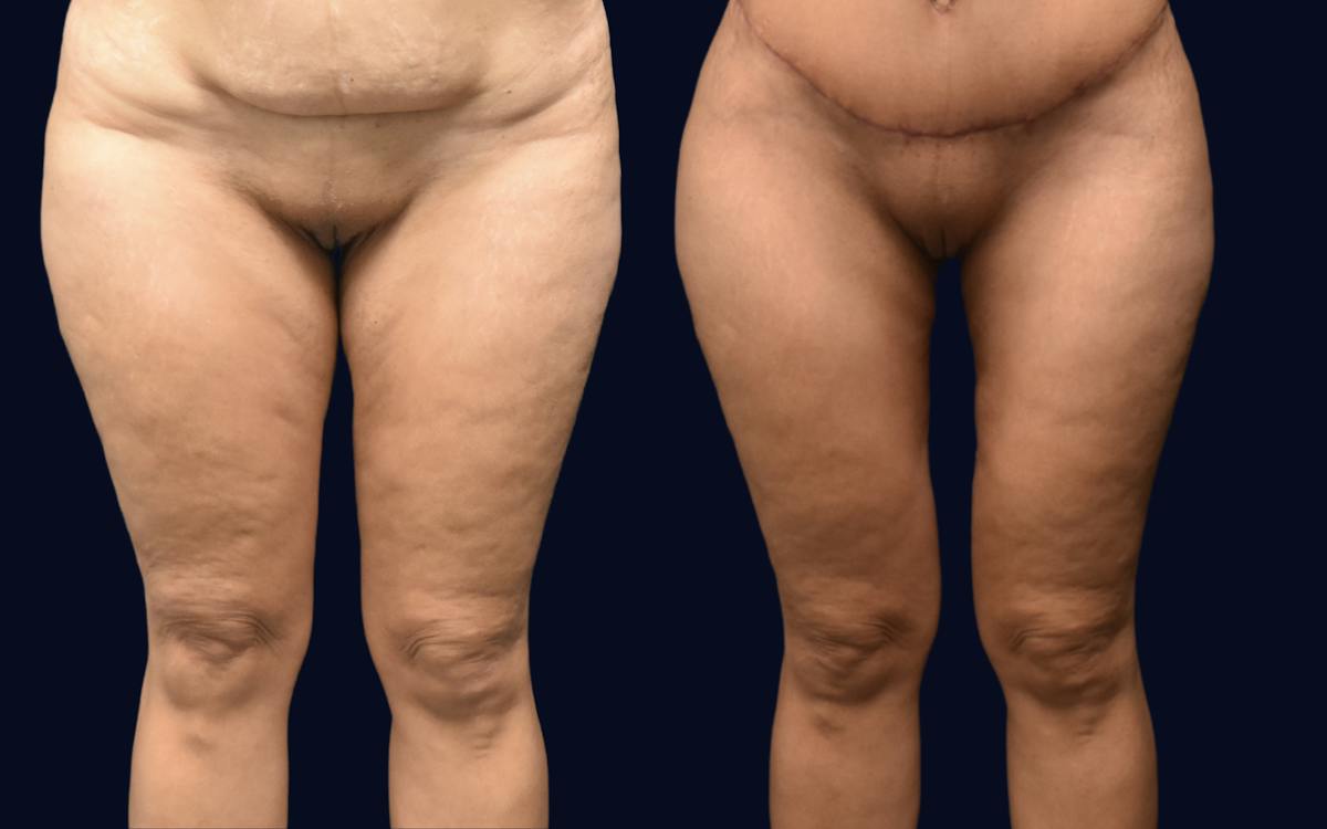 Thigh Lift Before & After Gallery - Patient 837698 - Image 2