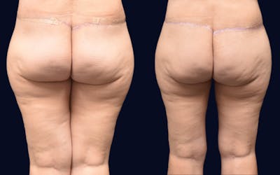 Thigh Lift Before & After Gallery - Patient 269398 - Image 1