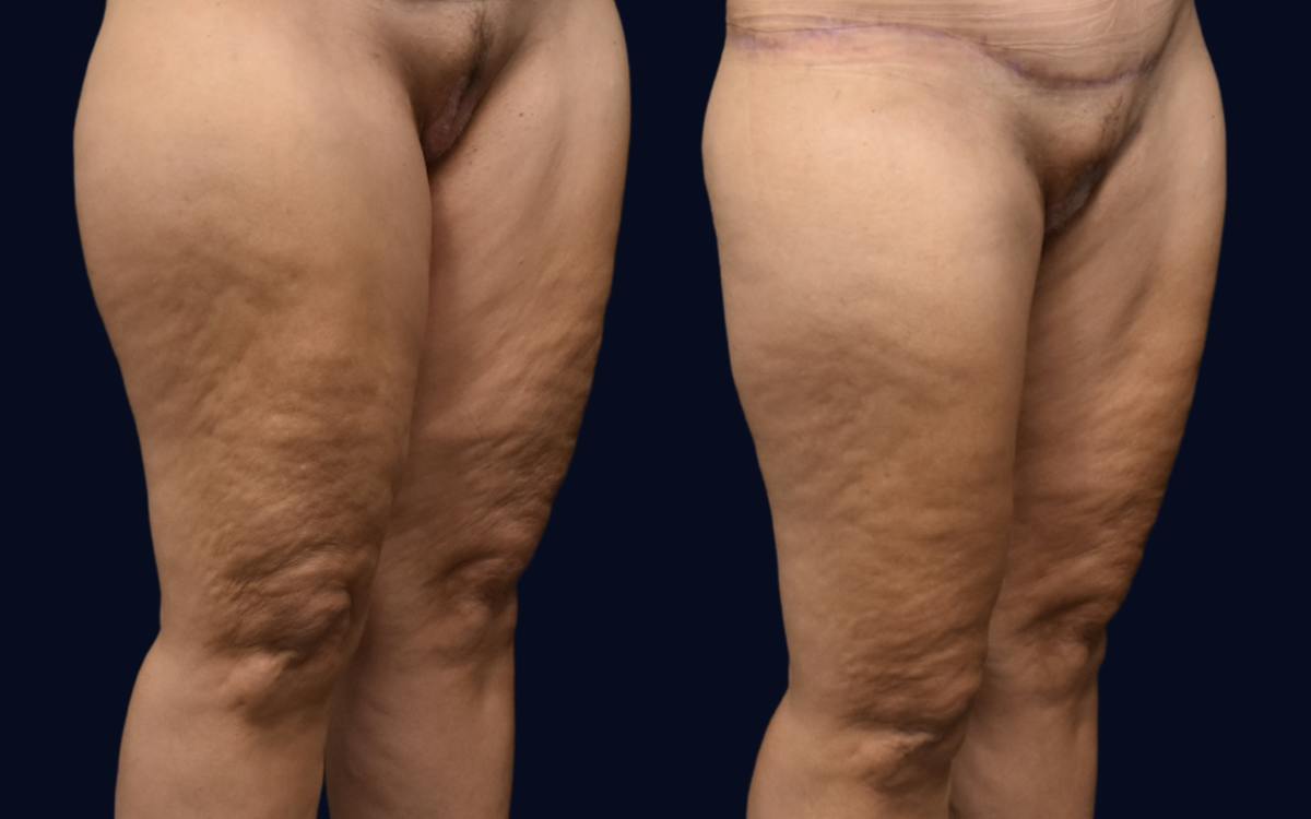 Thigh Lift Before & After Gallery - Patient 269398 - Image 3