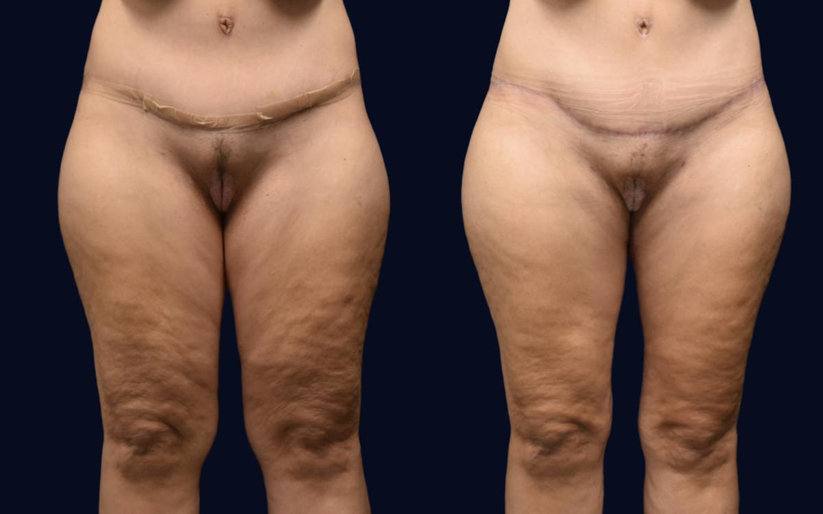 Thigh Lift Before & After Gallery - Patient 269398 - Image 2