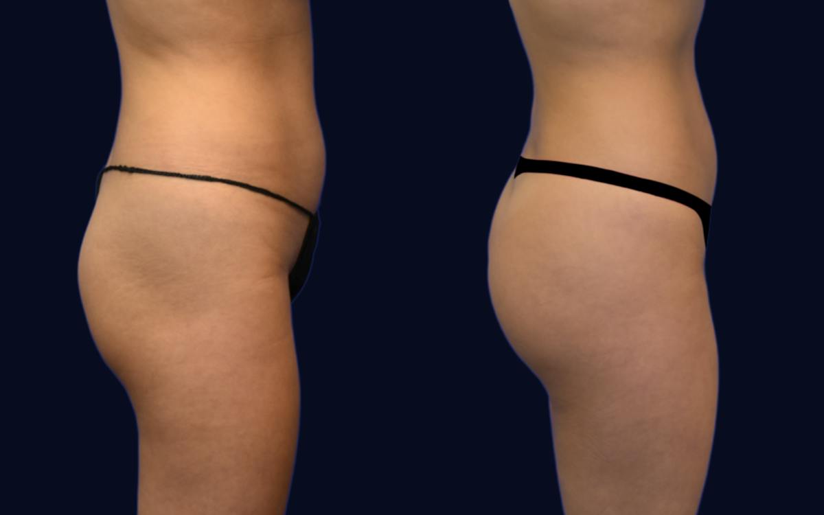 Brazilian Butt Lift Before & After Gallery - Patient 150142 - Image 3