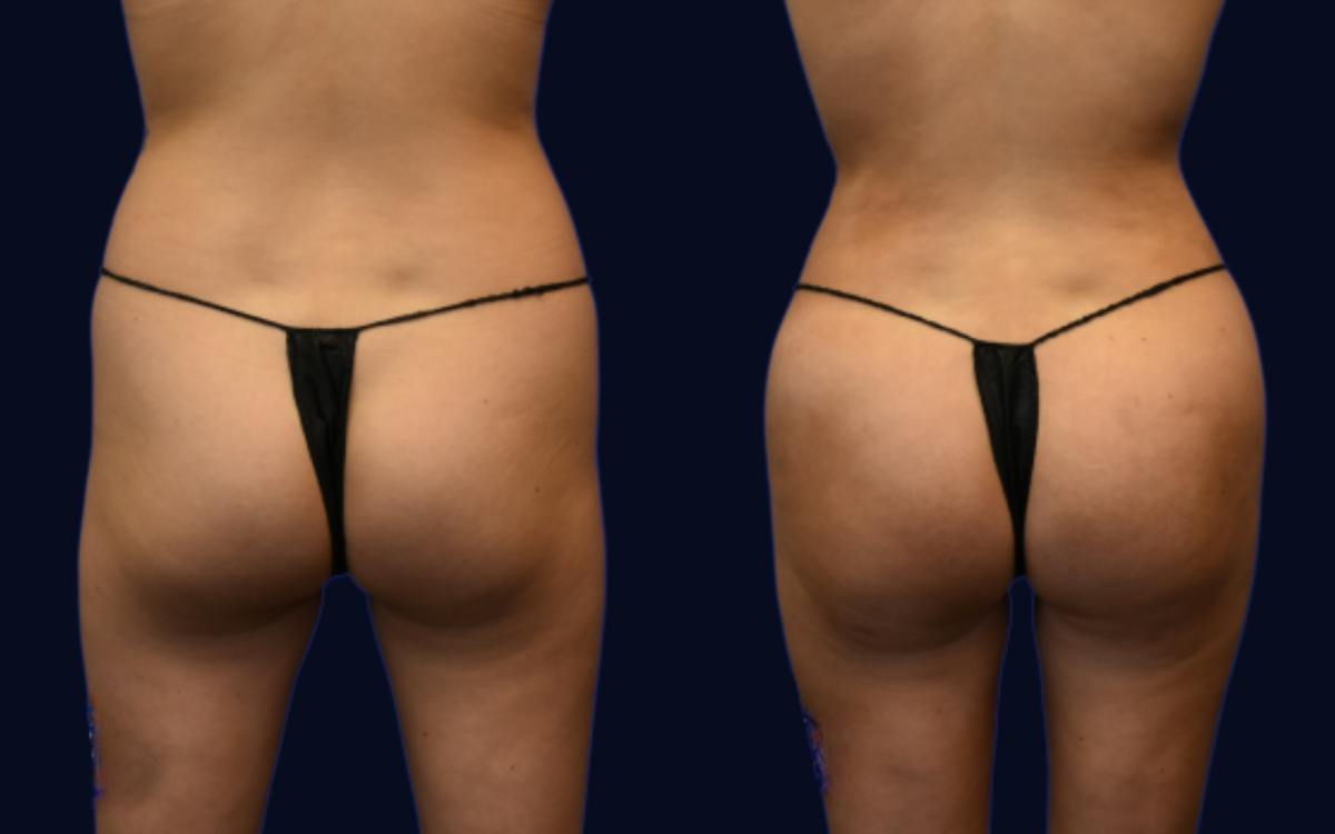Brazilian Butt Lift Before & After Gallery - Patient 150142 - Image 1