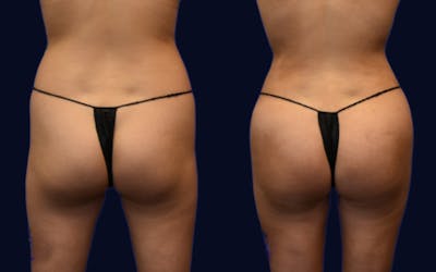 Brazilian Butt Lift Before & After Gallery - Patient 150142 - Image 1