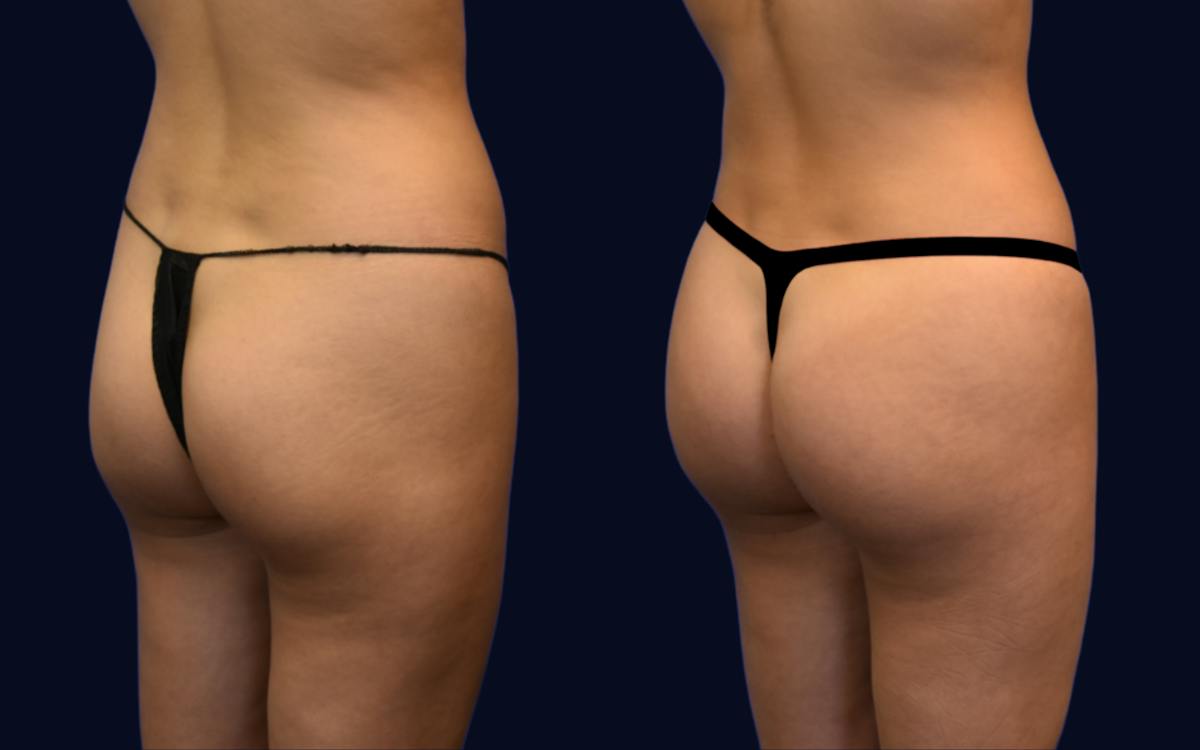 Brazilian Butt Lift Before & After Gallery - Patient 150142 - Image 2