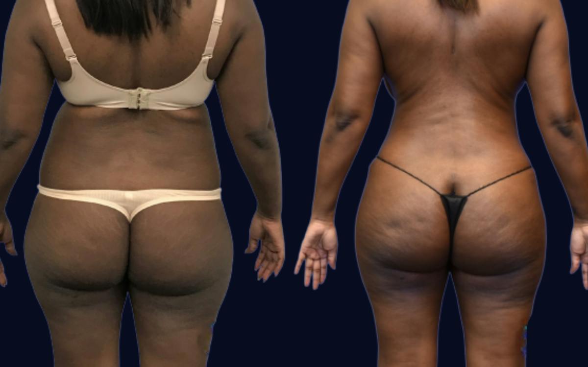 Brazilian Butt Lift Before & After Gallery - Patient 413266 - Image 1