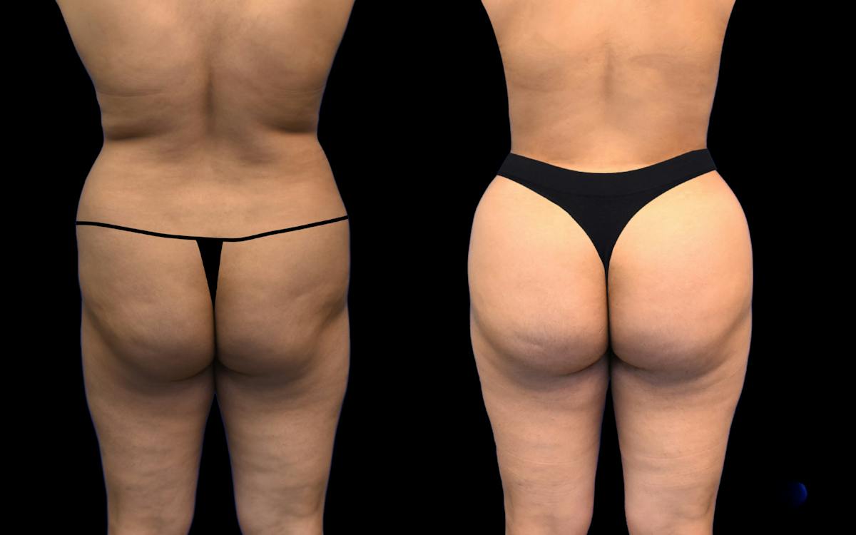 Brazilian Butt Lift Before & After Gallery - Patient 216499 - Image 1
