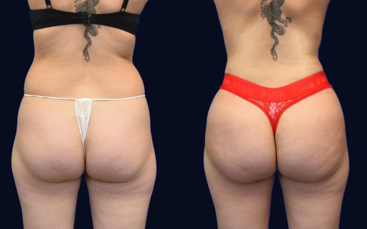 Brazilian Butt Lift Before & After Gallery - Patient 580261 - Image 1
