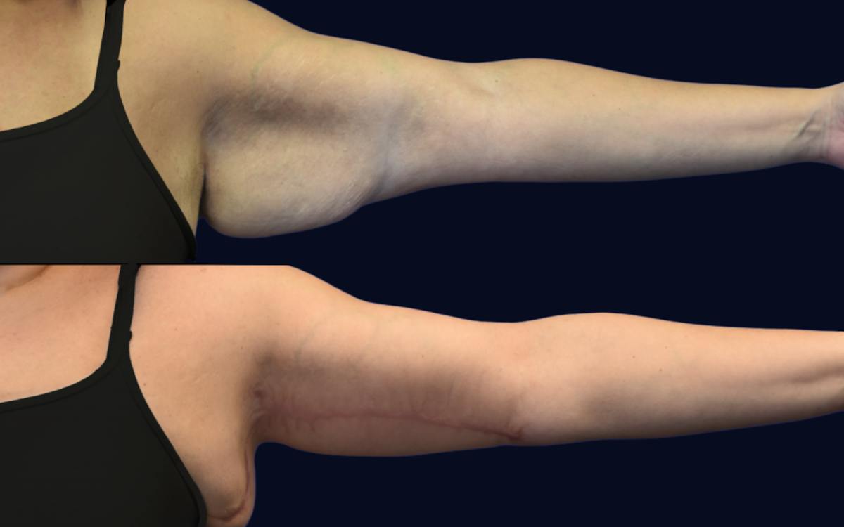 Brachioplasty (Arm Lift) Before & After Gallery - Patient 185832 - Image 1
