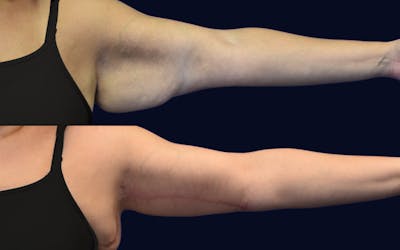 Brachioplasty (Arm Lift) Before & After Gallery - Patient 185832 - Image 1
