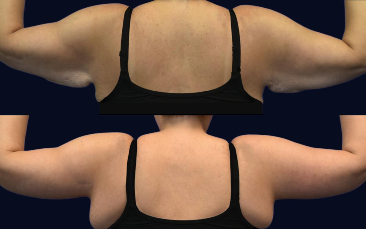 Brachioplasty (Arm Lift) Before & After Gallery - Patient 185832 - Image 2
