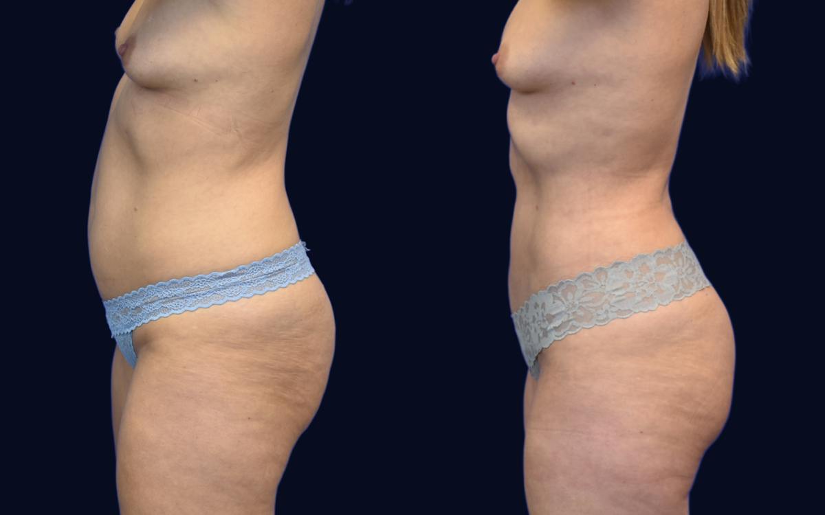 Liposuction Before & After Gallery - Patient 184263 - Image 3