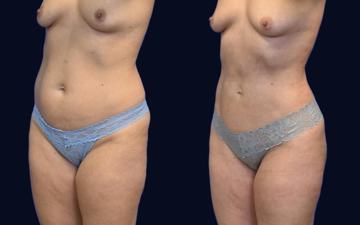 Liposuction Before & After Gallery - Patient 184263 - Image 2