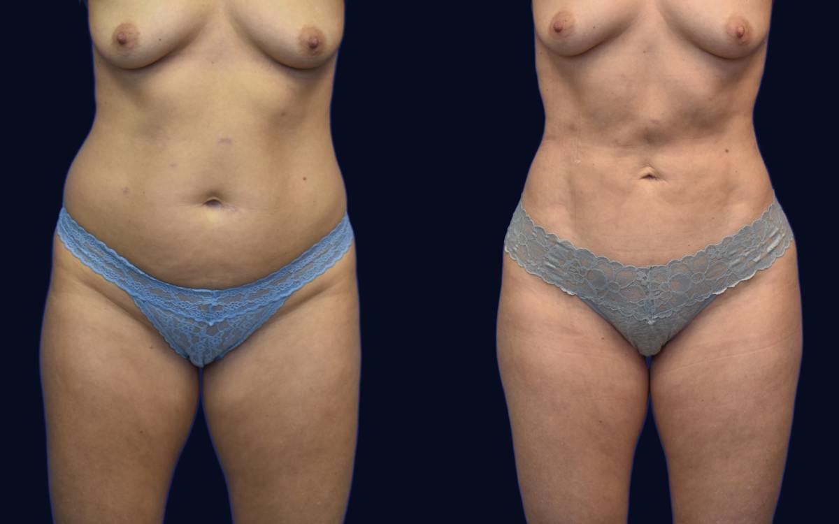 Liposuction Before & After Gallery - Patient 184263 - Image 1