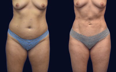 Liposuction Before & After Gallery - Patient 184263 - Image 1