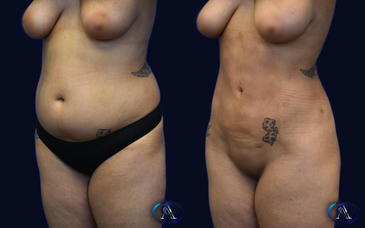 Liposuction Before & After Gallery - Patient 112126 - Image 2