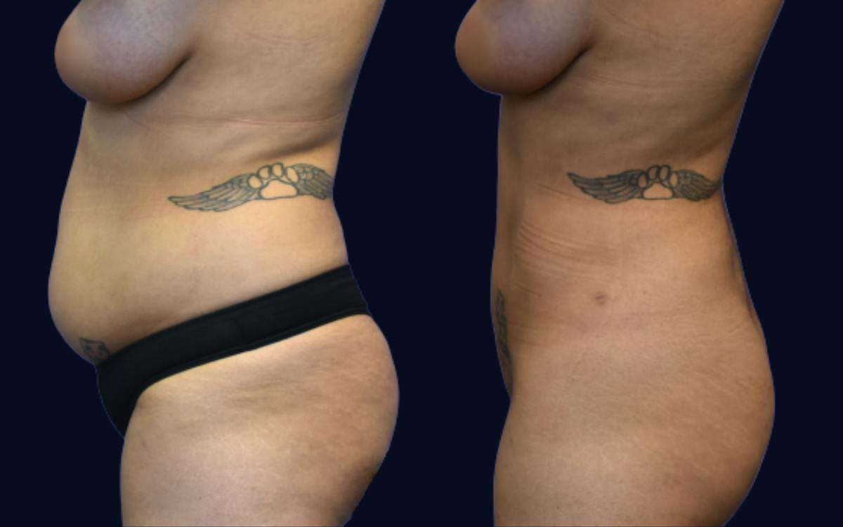 Liposuction Before & After Gallery - Patient 112126 - Image 3