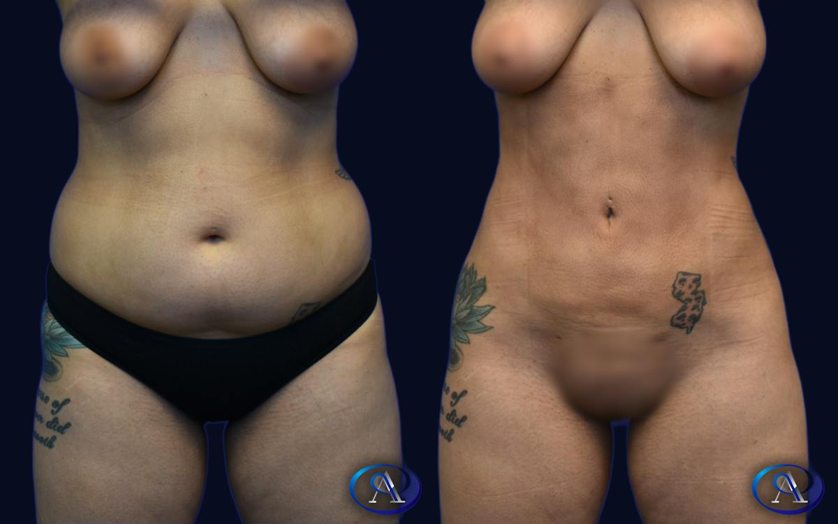 Liposuction Before & After Gallery - Patient 112126 - Image 1