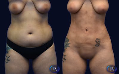 Liposuction Before & After Gallery - Patient 112126 - Image 1