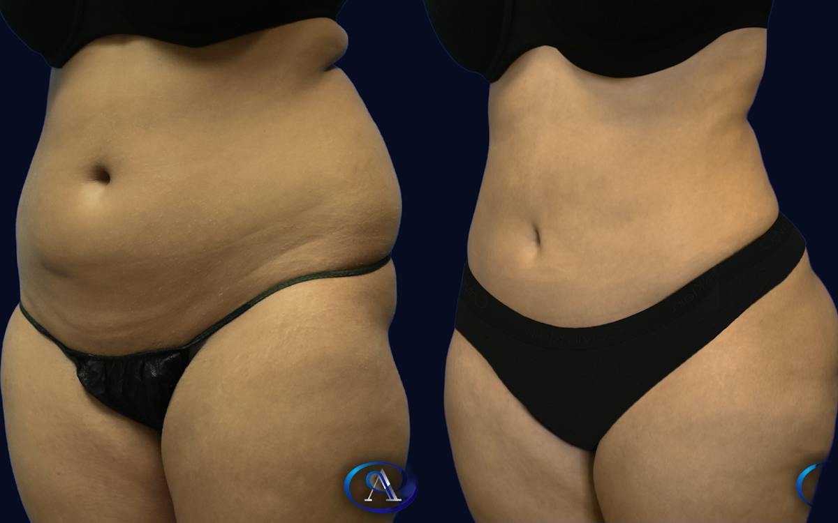 Liposuction Before & After Gallery - Patient 233771 - Image 2