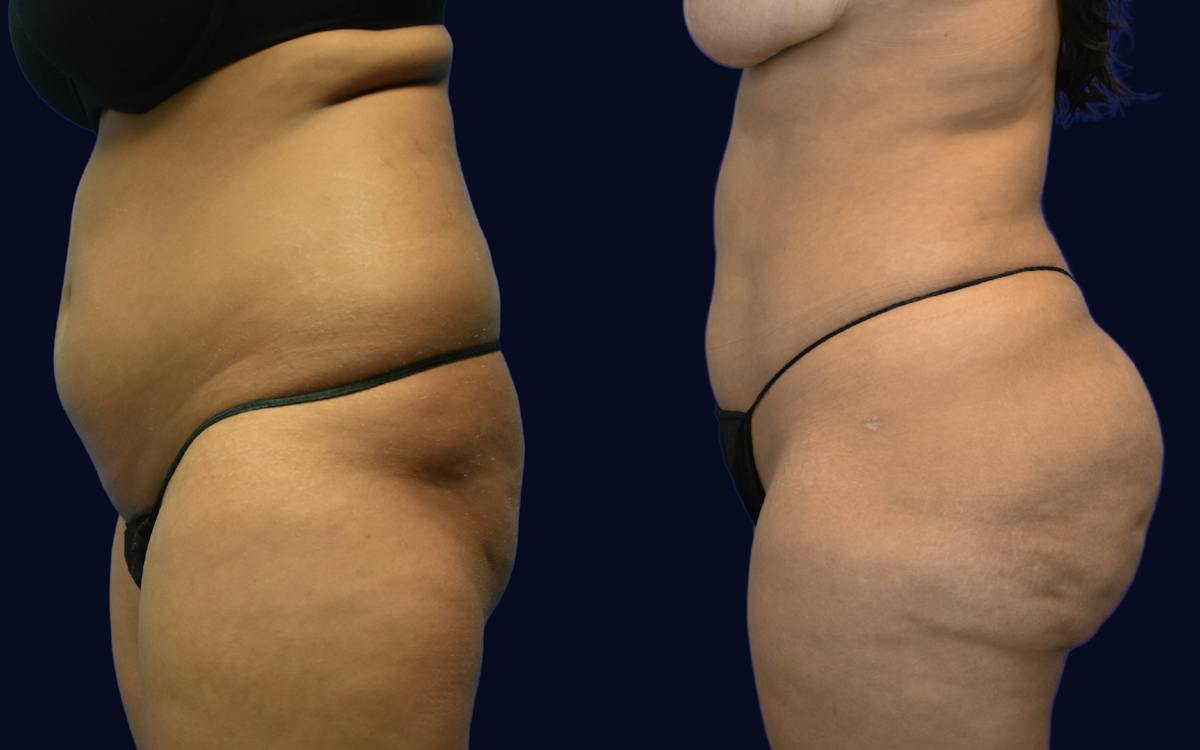Liposuction Before & After Gallery - Patient 233771 - Image 3