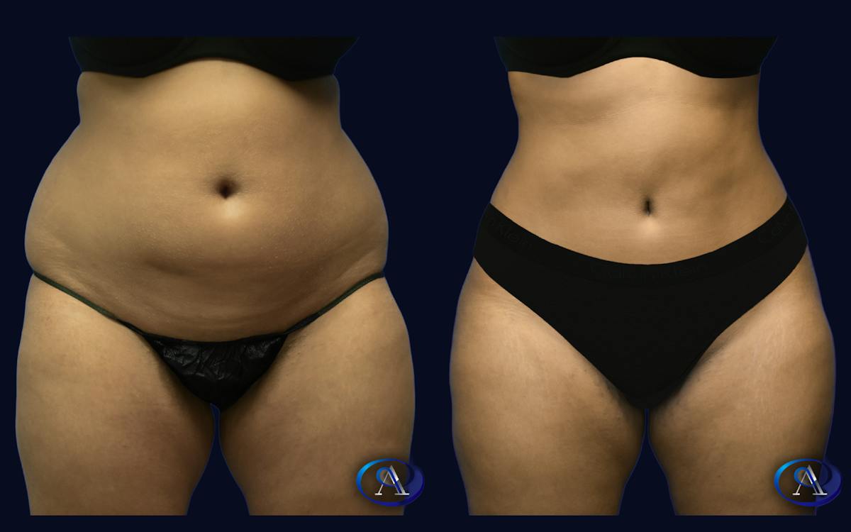 Liposuction Before & After Gallery - Patient 233771 - Image 1