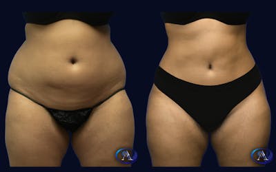 Liposuction Before & After Gallery - Patient 233771 - Image 1
