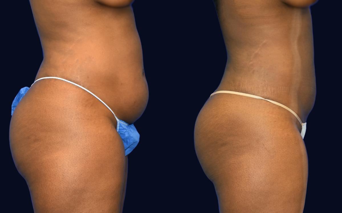 Liposuction Before & After Gallery - Patient 232343 - Image 3