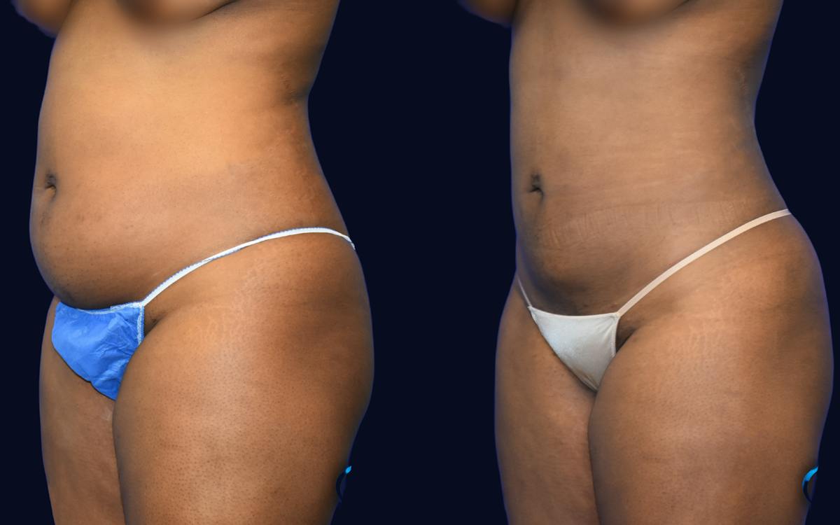 Liposuction Before & After Gallery - Patient 232343 - Image 2