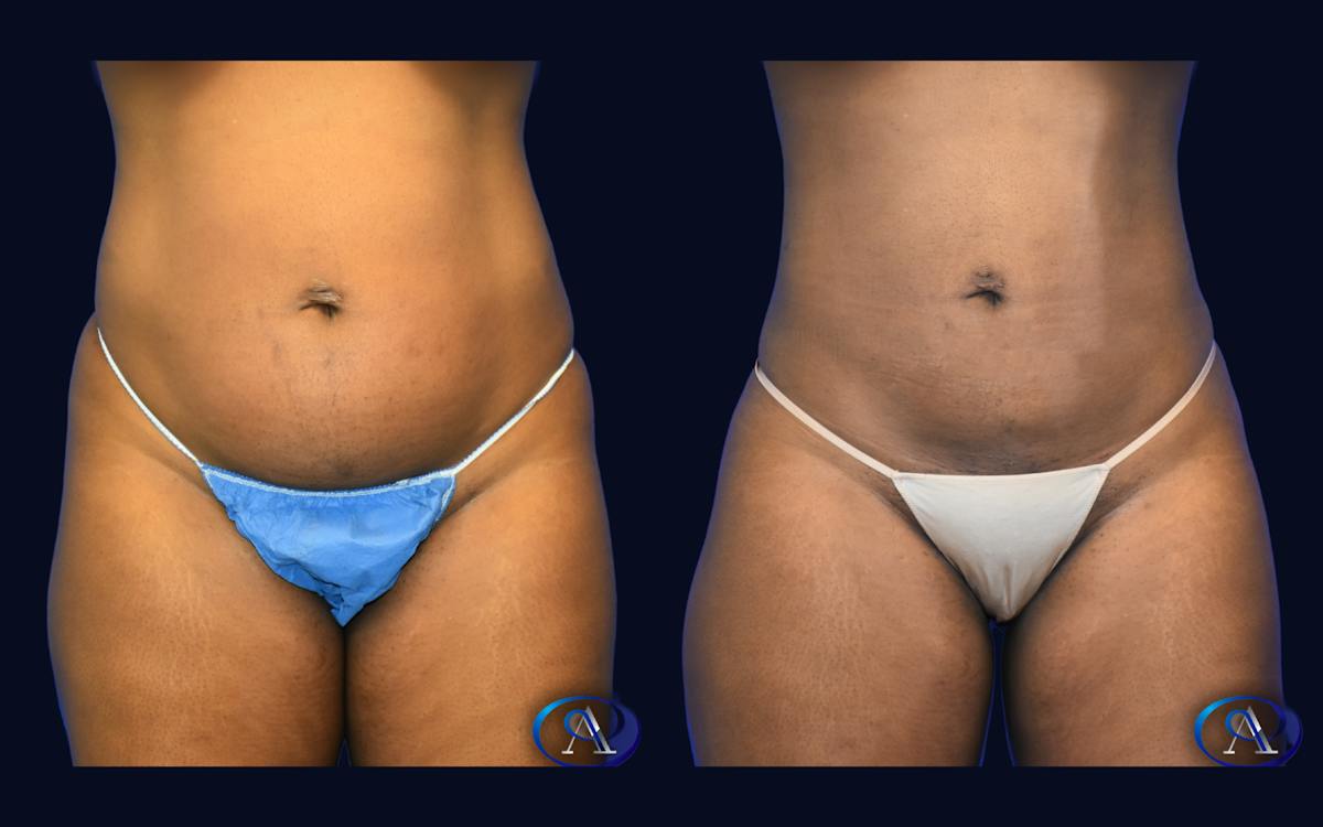Liposuction Before & After Gallery - Patient 232343 - Image 1