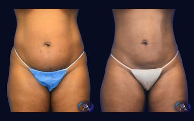 Liposuction Before & After Gallery - Patient 232343 - Image 1