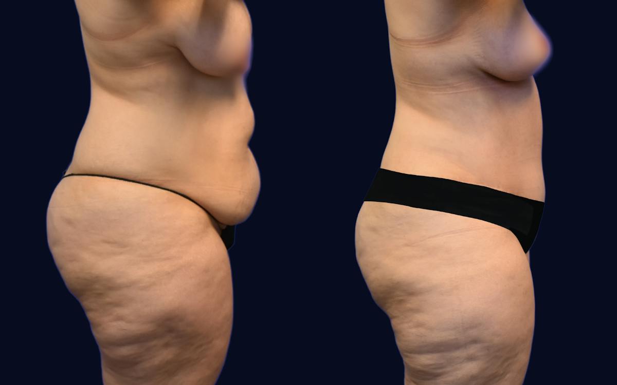 Abdominoplasty (Tummy Tuck) Before & After Gallery - Patient 247746 - Image 2