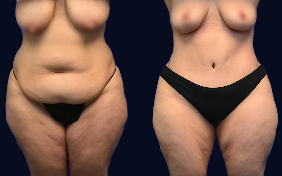 Abdominoplasty (Tummy Tuck) Before & After Gallery - Patient 247746 - Image 1