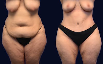 Abdominoplasty (Tummy Tuck) Before & After Gallery - Patient 247746 - Image 1