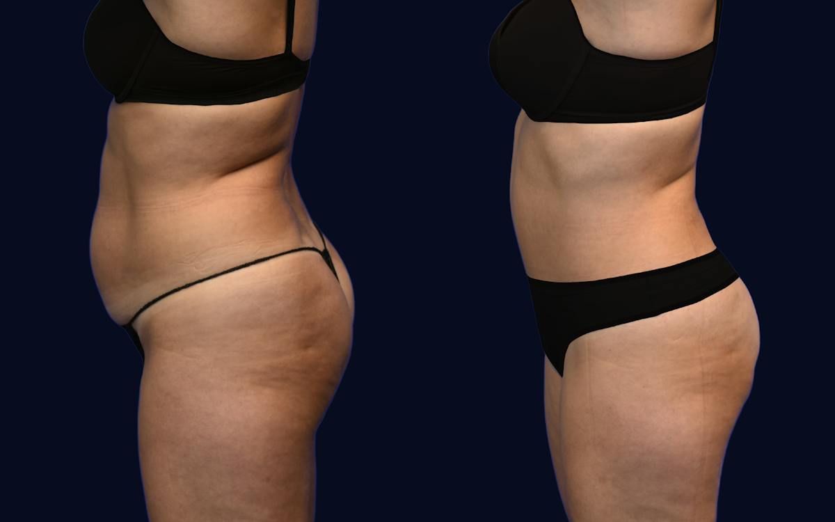 Abdominoplasty (Tummy Tuck) Before & After Gallery - Patient 137891 - Image 3